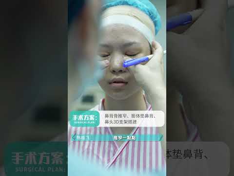鼻部細調