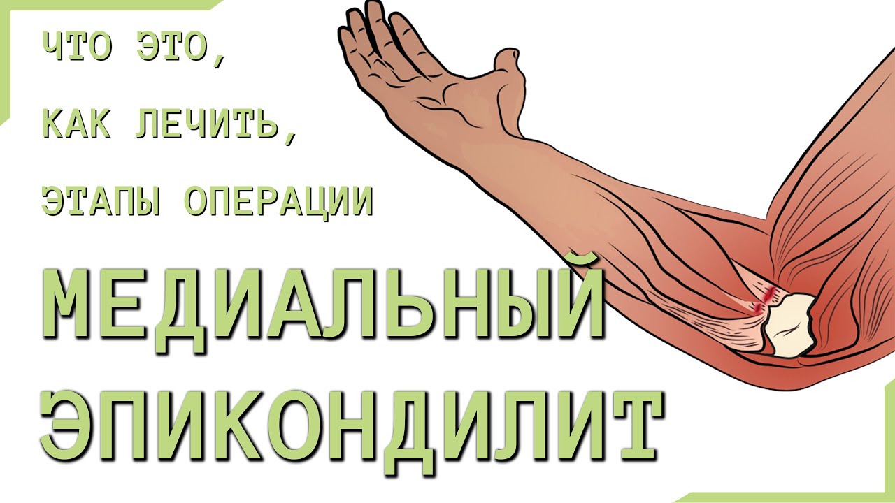 Латеральный эпикондилит мкб 10. Медиальный эпикондилит локтевого. медиальный эпикондилит блокада. латеральный эпикондилит упражнения. медиальный эпикондилит лфк.