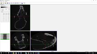 Celebrity skyscan microCT analysis 2/3, alignment of data orientation and segmentation of dataset Wealth