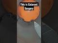 Entire cataract surgery in less than a minute