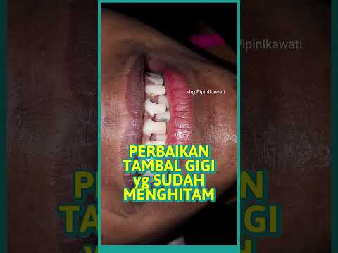 TAMBAL GIGI yg