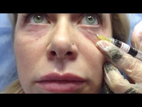 АирисКом студенты учатся: Филлеры. Заполнение морщин гиалуроновой кислотой область вокруг глаз.