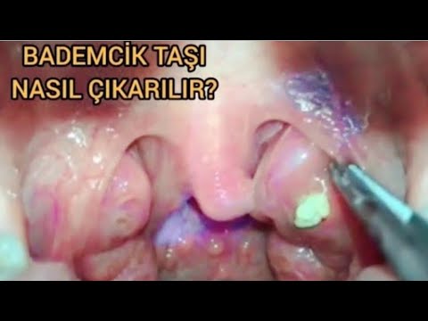 Video: Badamcıq daşlarını çıxartmalısınız?