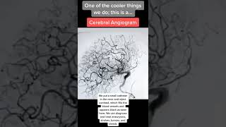 Most Beautiful Cerebral Angiogram