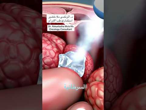 تجميد الاورام السرطانيه 