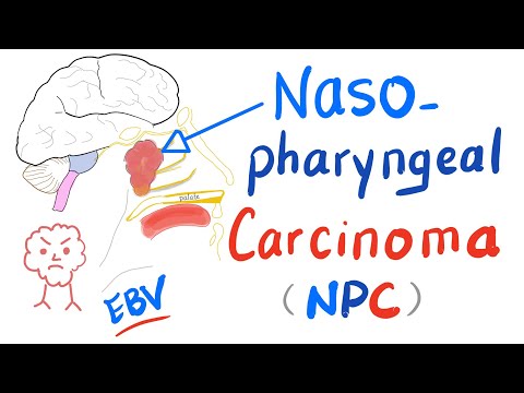Nasopharyngeal Carcinoma (NPC): Location, Risk Factors, Clinical Picture, Diagnosis& Management