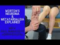 Morton's Neuroma and Metatarsalgia: What's the Difference?