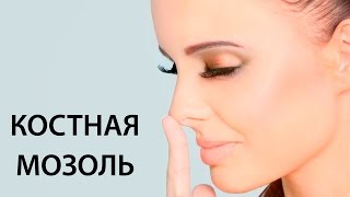 видео: КОСТНАЯ МОЗОЛЬ // РИНОПЛАСТИКА картинка: КОСТНАЯ МОЗОЛЬ // РИНОПЛАСТИКА