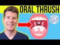 Doctor explains oral thrush oral candidiasis  symptoms treatment  prevention in adultsbabies