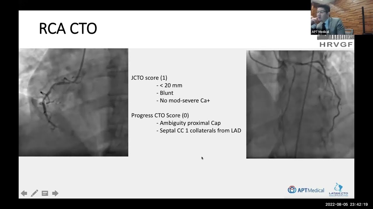 CTO case sharing - Dr. Misael A. Medina Servín