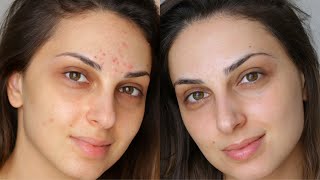 BENZOYL PEROXIDE: BEST WAY TO GET RID OF SPOTS
