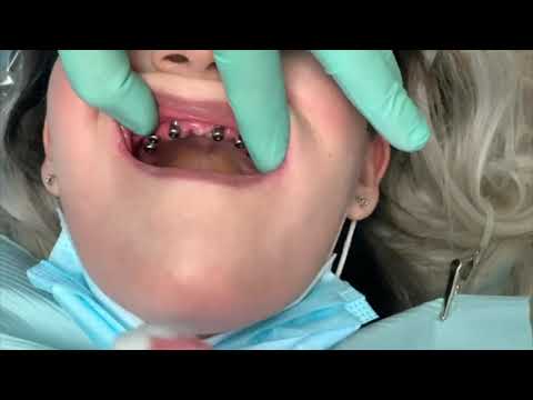 Hybrid Implant Denture in Houston Texas