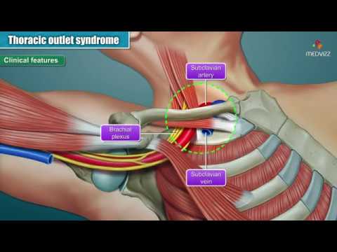 Video: Paget-Schroetter Syndrome - Causes, Symptoms And Treatment