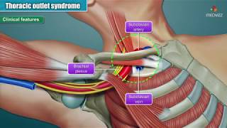 21 Thoracic Outlet Syndrome