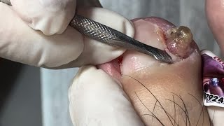 Ep_6521 Ingrown toenail removal  👣 ไม่งัด ไม่แงะ ไม่กด ไม่บีบ แล้วหนูจะหาย 😄 (clip from Thailand)
