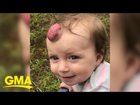 Toddler has giant blood-filled tumor removed and now you can barely tell it was there l GMA