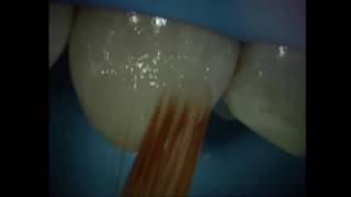 Direct composite partial buccal veneering