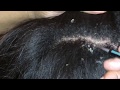 Dandruff Flakes! Pt. 2 of 4