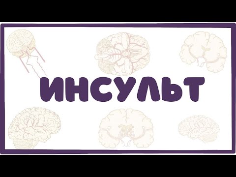 Инсульт - причины, симптомы, лечение (неврология лекция)