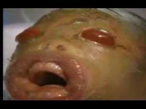 bambino malato di ittiosi, no alieno