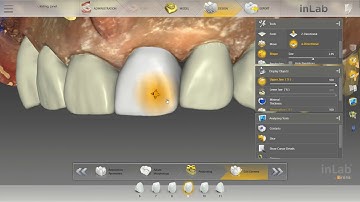 Adjusting Distal Contour Line InLab SW 18