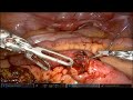 Gallstone Ileus - ATX Robotic Surgery