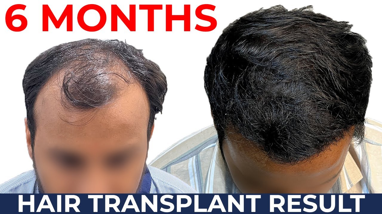 6-months-hair-transplant-result-hair-transplant-journey-month-by