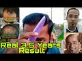 After 35 years my best hair transplant result  25 years guarantee of hair transplant