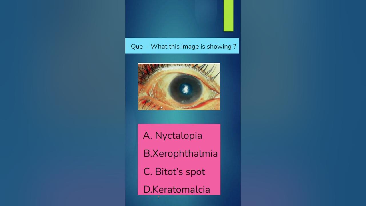 What is Xerophthalmia ? OSCE, Spot Diagnosis Shorts