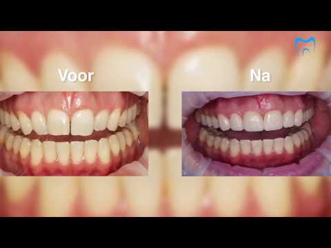 Video: Kan lumineers tande verleng?