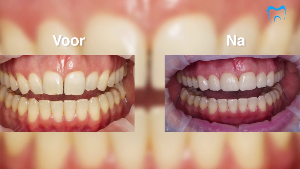 facings geven u weer een mooie, natuurlijke lach! Vink Dental