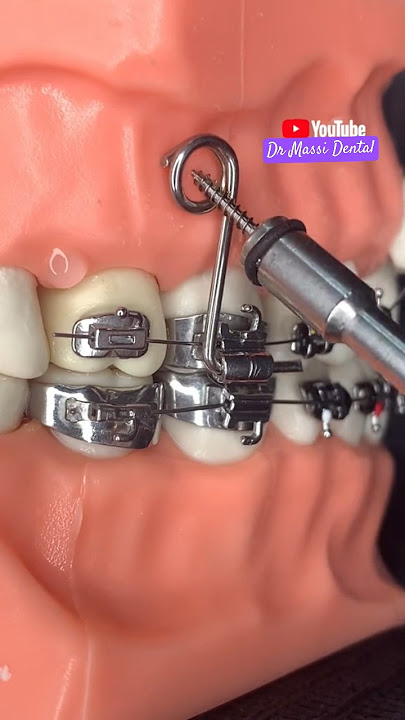 Dental BRACES, ORTHODONTICS