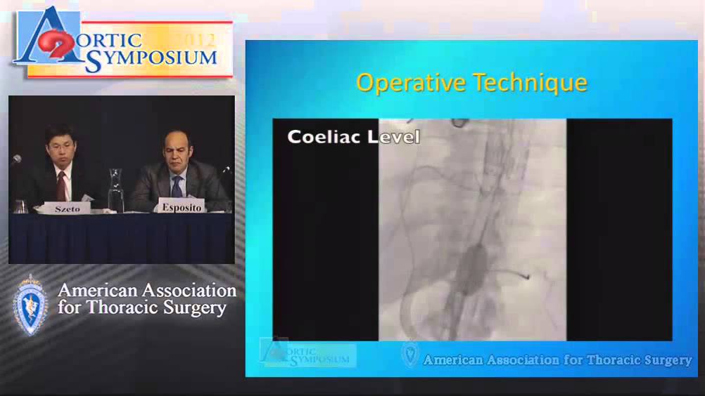 Stent Assisted Balloon Induced YouTube