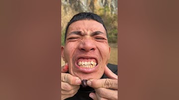 How I Cured a Bug Bite with Yogurt in theWild | Survival Hacks