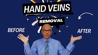 Hand Vein Removal by Sclerotherapy: Hand Vein Sclerotherapy Guide for Healthcare Professionals.