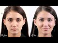 How long do dermal fillers last