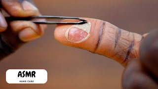 Peeling My Burnt Thumb | ASMR