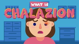 What is Chalazion?