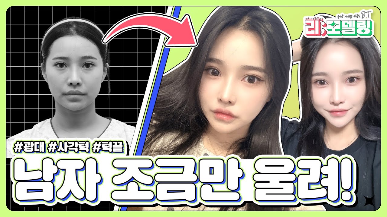 [비티성형외과 리얼스토리] 윤곽3종 4개월 지난 후기 VLOG