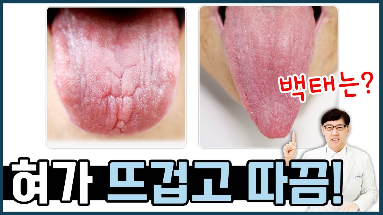 위축성설염/ 혀가 뜨겁고 따끔해요. 혀가 갈라지고 아파요 - YouTube