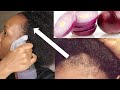 2ways to use ONION 🌰 JUICE For MASSIVE HAIR GROWTH|Jalia Walda