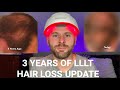 3 years of using low level laser therapy lllt for hair loss  my results