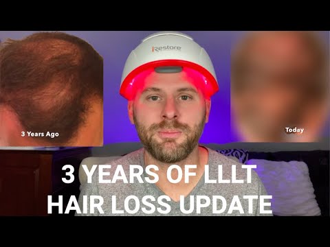 Видео: 3 Years Of Using Low Level Laser Therapy (LLLT) For Hair Loss - My Results.