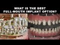 What is the Best Full-Mouth Implant Option? Creating a Syton™ 7-Star