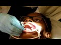 12 Year Old Gets Braces
