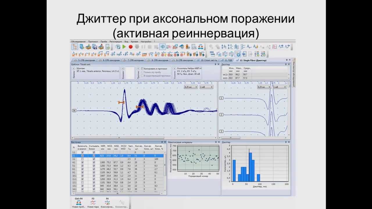 Онлайн классификация джиттера. Игольчатая электромиография. - YouTube