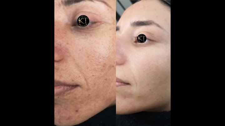 Cilt bakımı dermapen cilt lekesi cilt sorunu