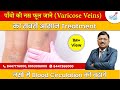      varicose veins    treatment  dr bimal chhajer  saaol