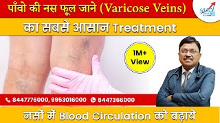 पाँवो की नस फूल जाने (Varicose Veins) का सबसे आसान Treatment | Dr. Bimal Chhajer | SAAOL