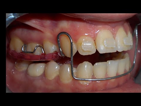 تدبير حالة سوء إطباق مع نموذج قلع غير متناظر الدكتور محمد يونس حجير